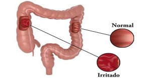 colon irritable