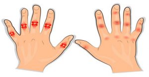 aliviar dolor de artritis