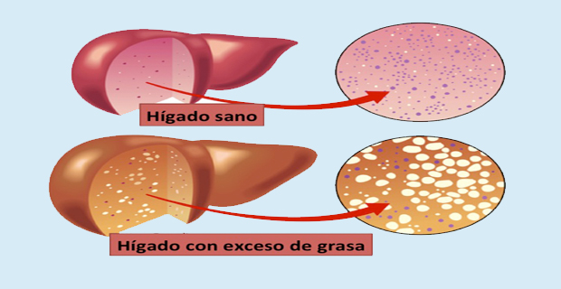 hígado graso