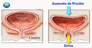 incontinencia urinaria