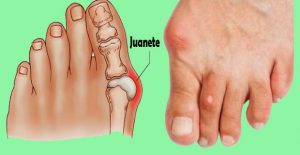 juanetes