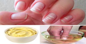 manchas blancas en las uñas
