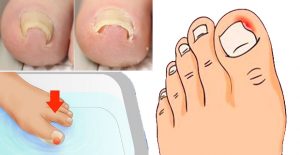 uñas encarnadas