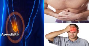 apendicitis