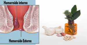 eliminar hemorroides