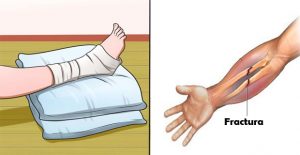 fracturas de huesos