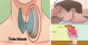 problema de tiroides