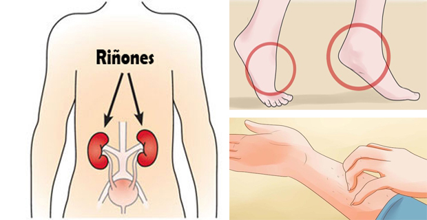 problemas de riñón