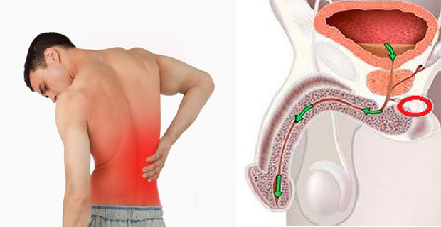 cáncer de próstata