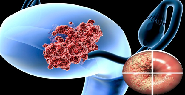 cáncer de útero