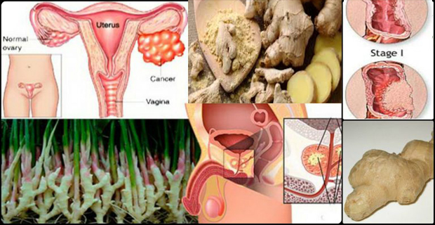 tipos de cáncer