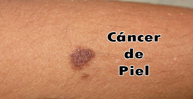 cáncer de piel