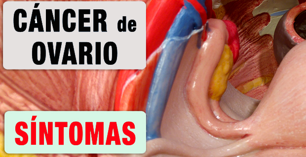 cáncer de ovarios