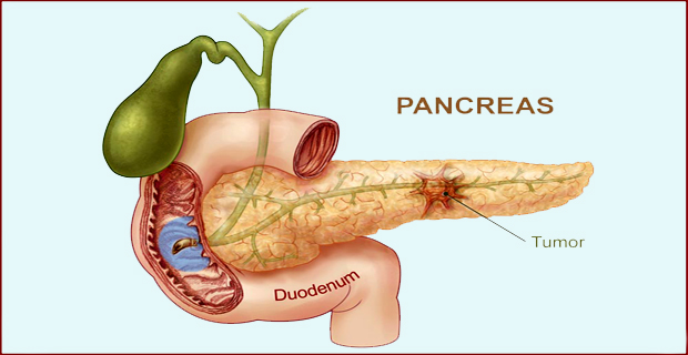 cáncer de páncreas