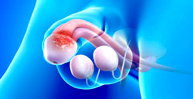 cáncer de pene