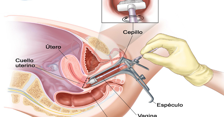 cáncer uterino