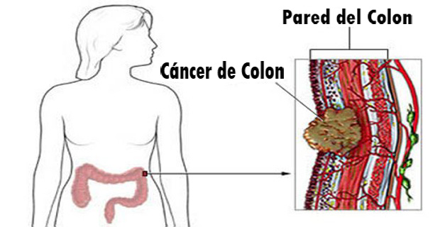 cáncer colorrectal