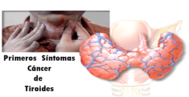 Sintomas de cancer intestino delgado