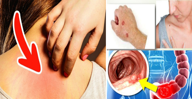 síntomas del cáncer